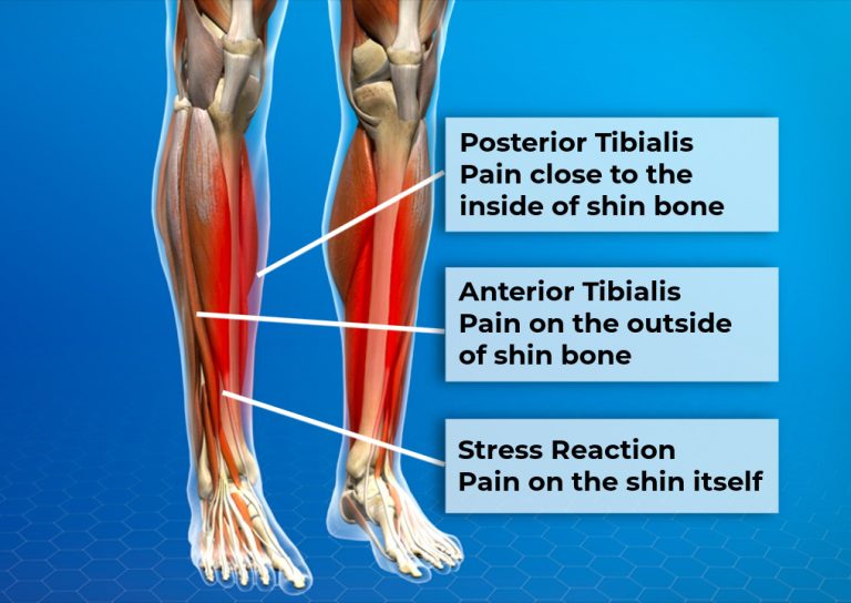 How to Get Rid of Shin Splints: Treat And Fully Recover