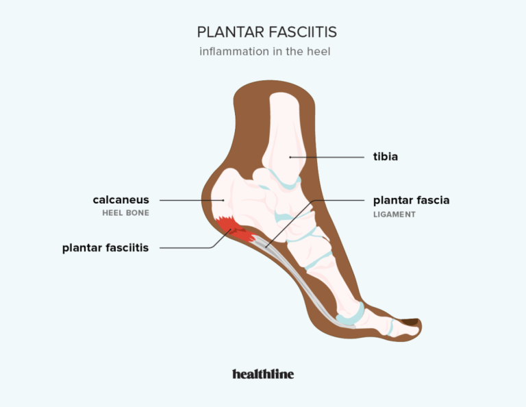 Plantar Fasciitis: Causes, Symptoms, Treatments