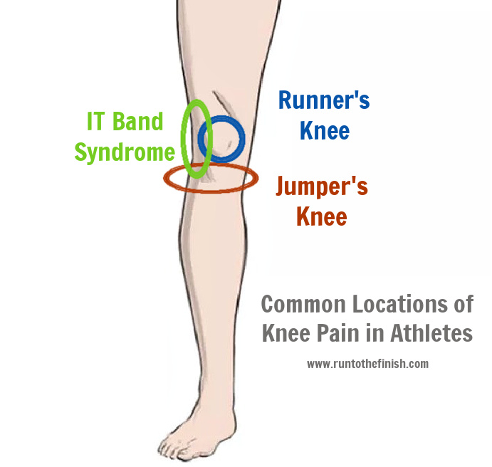 Runners Knee Vs Jumpers Knee