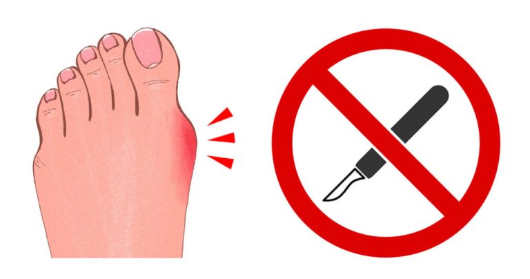 How to Fix Walking on Toes: Top Solutions for a Toe-Tapping Dilemma