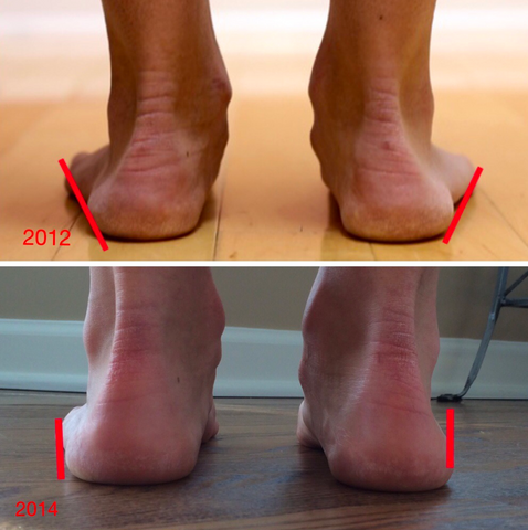 Is Zero Drop Good for Flat Feet?