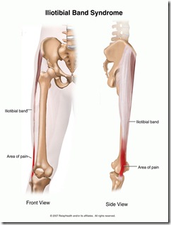 Can Running Shoes Cause It Band Syndrome?