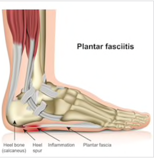 Can You Be a Runner With Plantar Fasciitis?