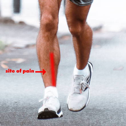 Do Shin Splints Go Away?