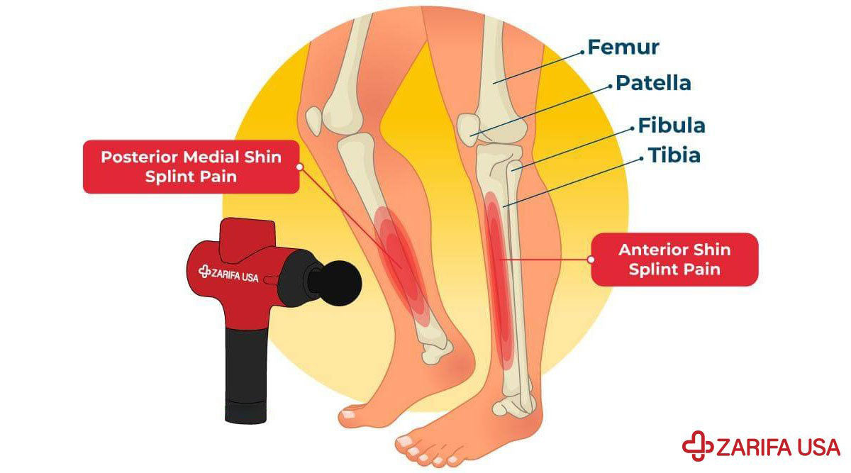 How Can I Test Myself for Shin Splints?