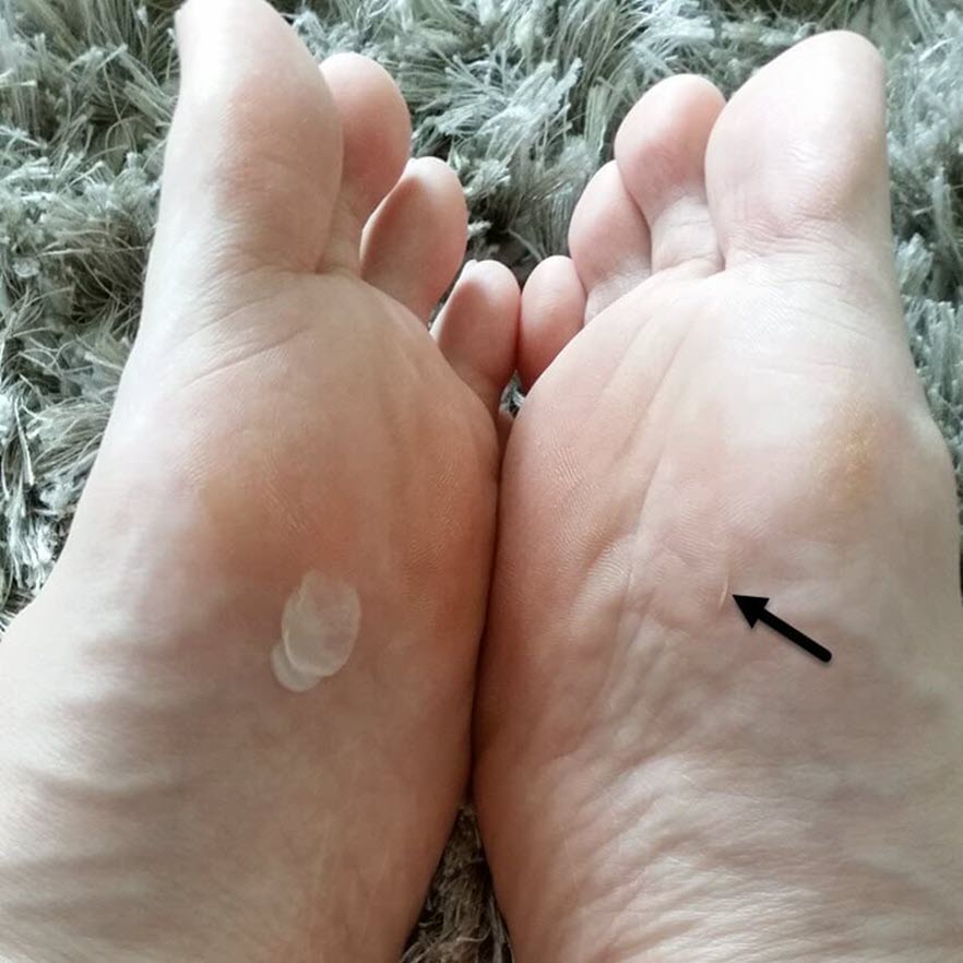 How Long Do Blisters Last?