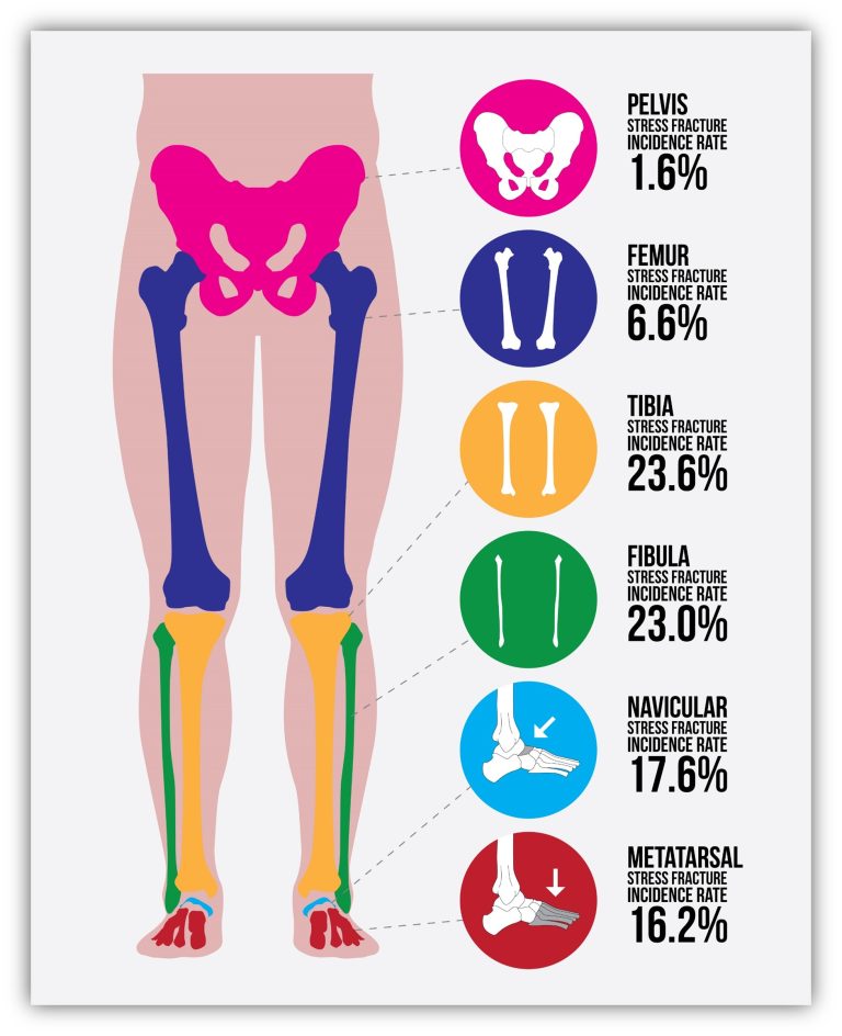 How Painful are Stress Fractures?