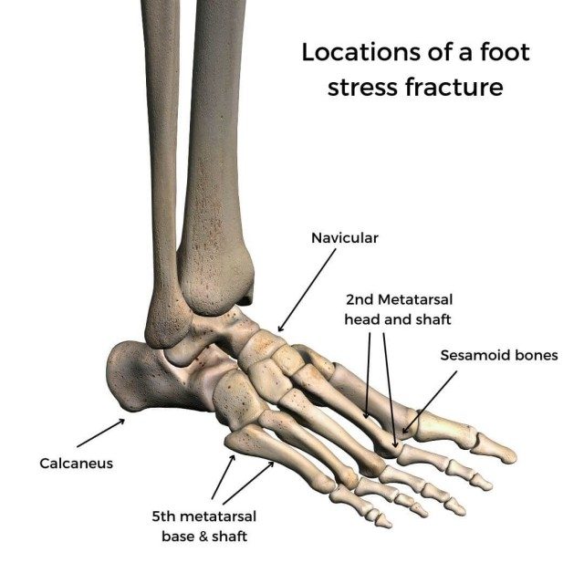 How to Heal a Stress Fracture?