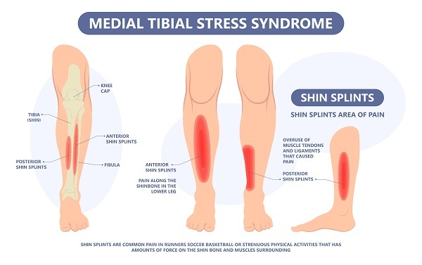 Is It Okay to Run With Shin Splints?