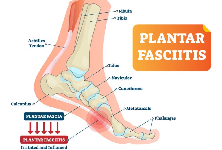 Is Massage Good for Plantar Fasciitis?