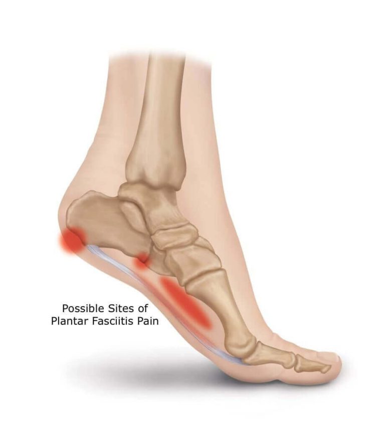 Is Plantar Fasciitis Permanent?