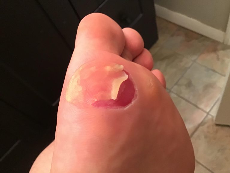 Should I Run If I Have Blisters?