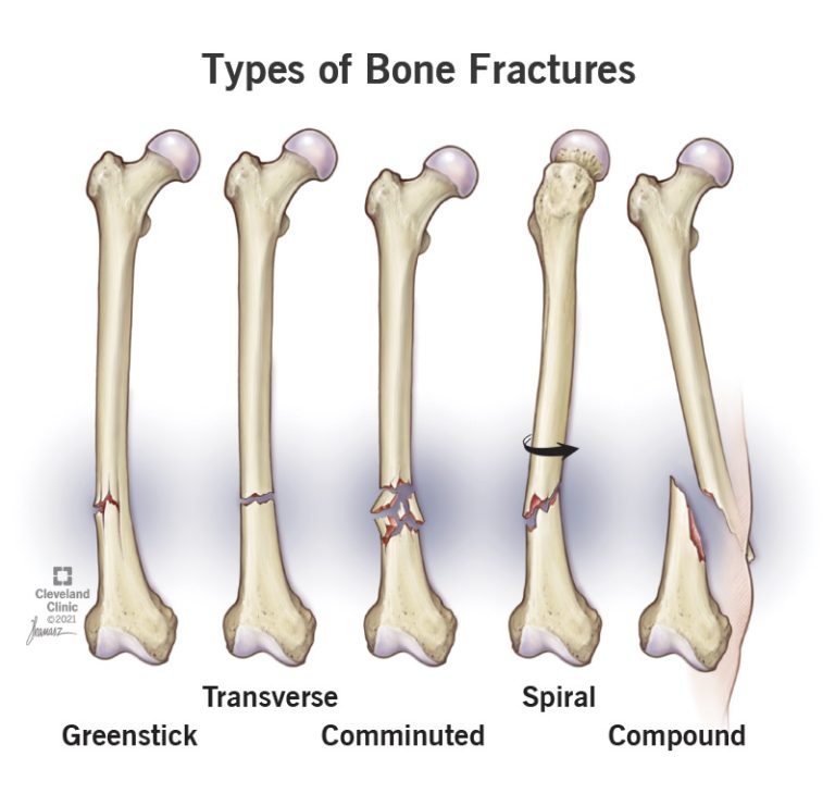 What are the 5 Types of Stress Fractures?