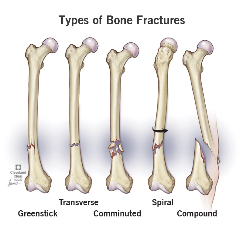 What are the 5 Types of Stress Fractures?