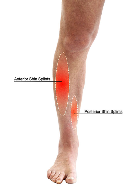 What are the Symptoms of Shin Splints?