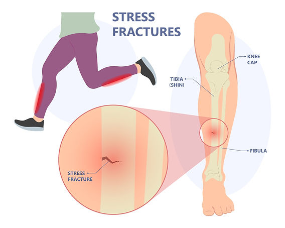 What Can Be Mistaken for a Stress Fracture?