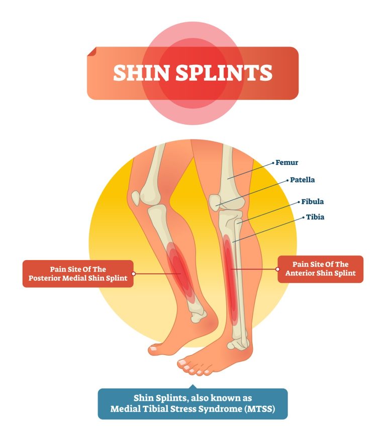 What Deficiency Causes Shin Pain?