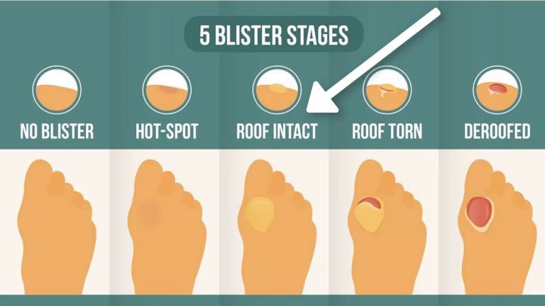 What is the Fastest Way to Heal a Blister?